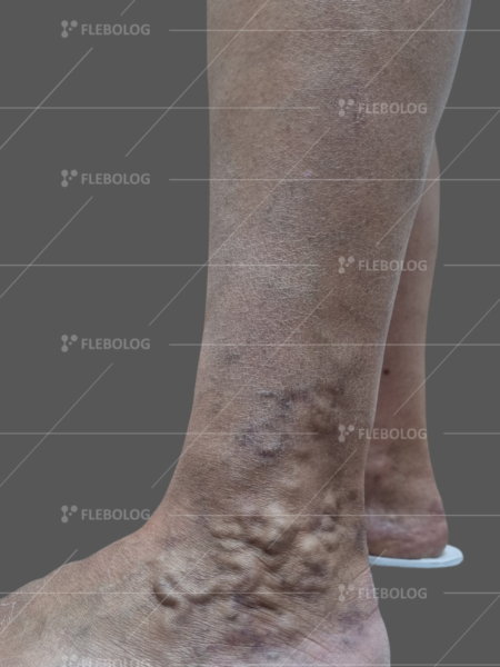 варикоз стопи фото до та після лікування - флеболог Барабой