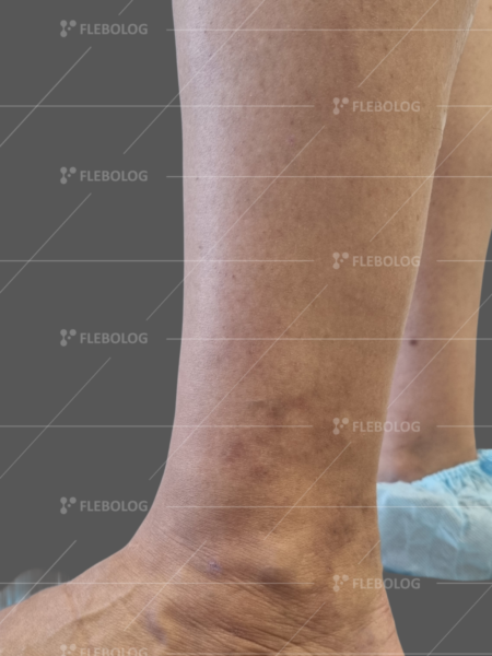 варикоз стопи фото до та після лікування - флеболог Барабой