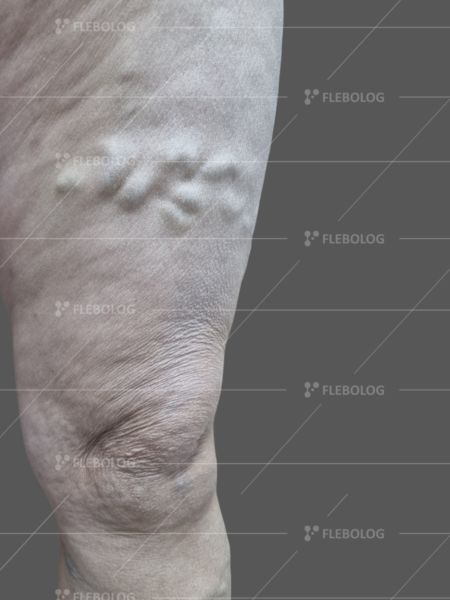варикоз на ногах фото до та після операції - флеболог Барабой