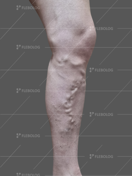 варикоз фото до та після - флеболог Барабой