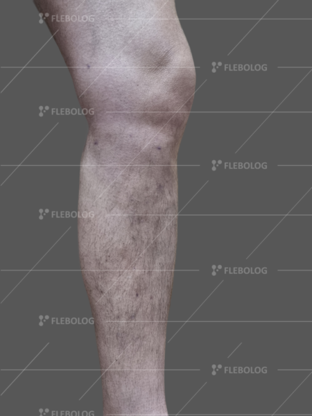 варикоз фото до та після - флеболог Барабой