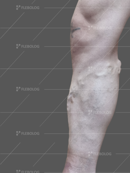 варикоз 5 ступеня фото до та після лікування - флеболог Барабой