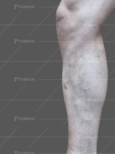 варикоз 5 ступеня фото до та після лікування - флеболог Барабой