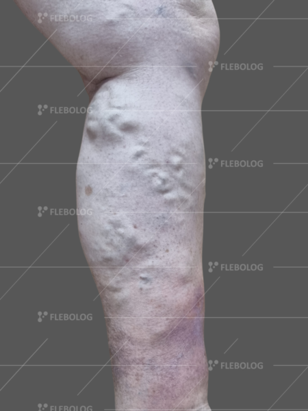 лікування варикозу до та після - флеболог Барабой