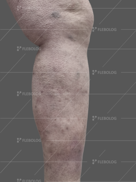 лікування варикозу до та після - флеболог Барабой