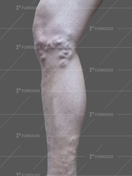 фото варикозних вен на нозі до та після лікування - флеболог Барабой