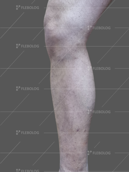 фото варикозних вен на нозі до та після лікування - флеболог Барабой