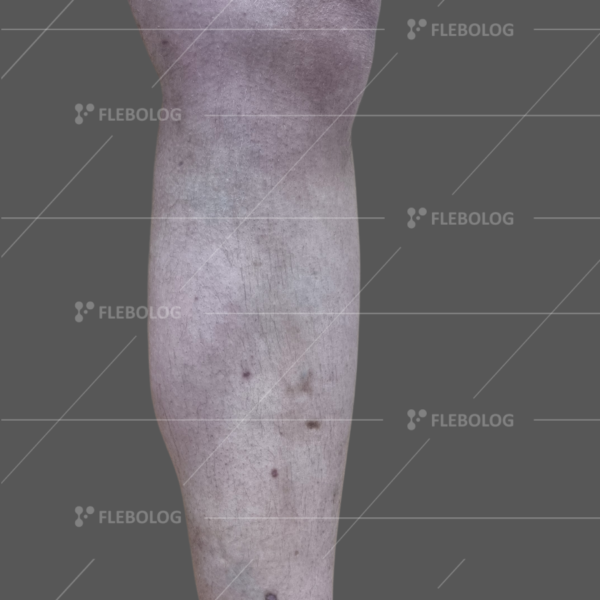 Лечение варикоза до и после - флеболог Барабой, фото 50