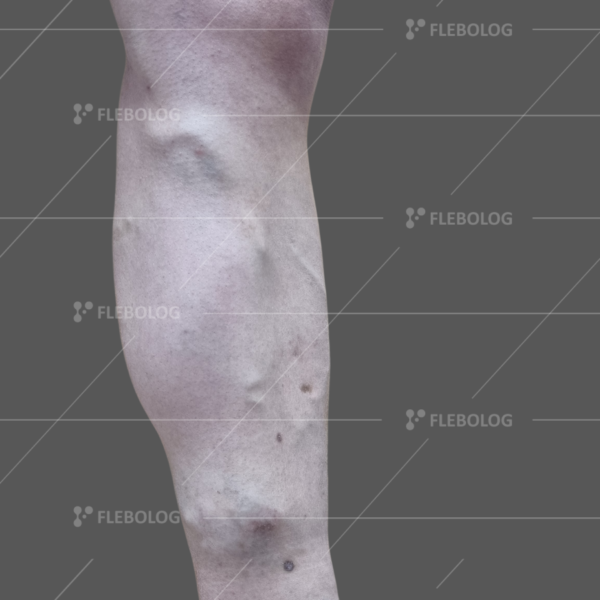 Лечение варикоза до и после - флеболог Барабой, фото 49