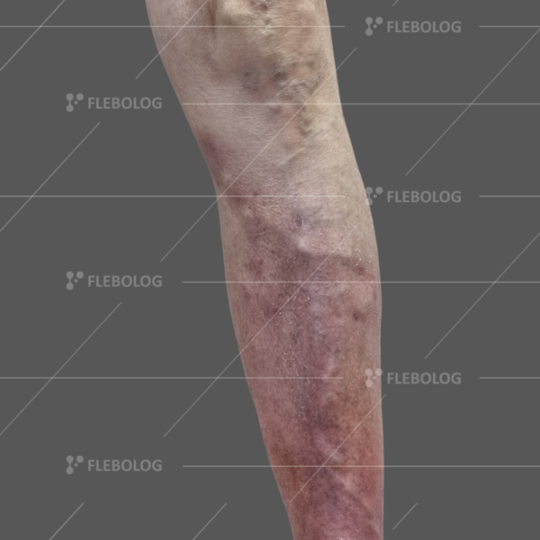 Лечение варикоза до и после - флеболог Барабой, фото 47