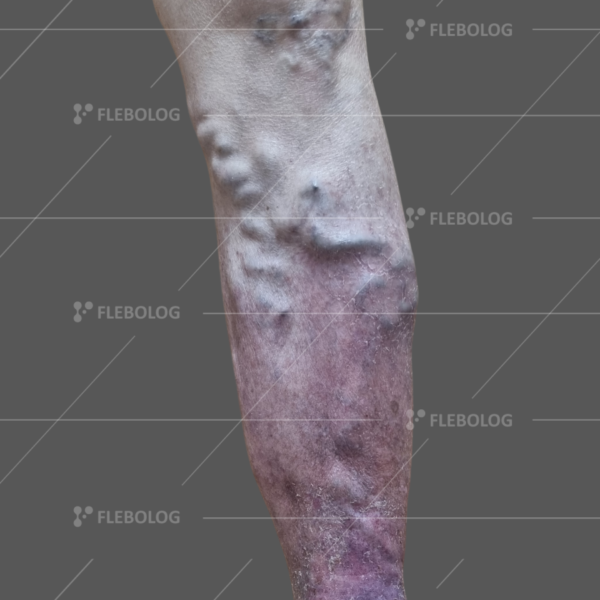 Лечение варикоза до и после - флеболог Барабой, фото 46