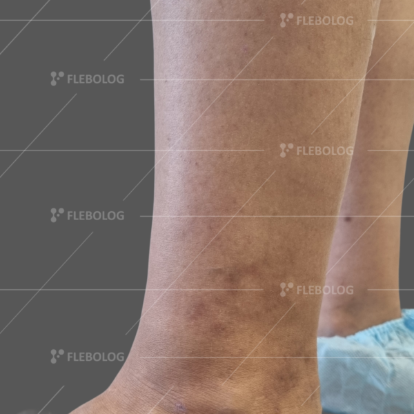 Лечение варикоза до и после - флеболог Барабой, фото 39