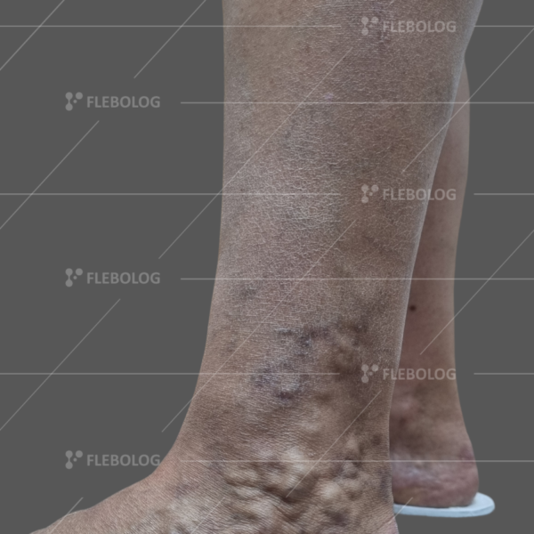 Лечение варикоза до и после - флеболог Барабой, фото 38