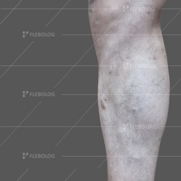 варикоз на коліні фото до та після операції - флеболог Барабой