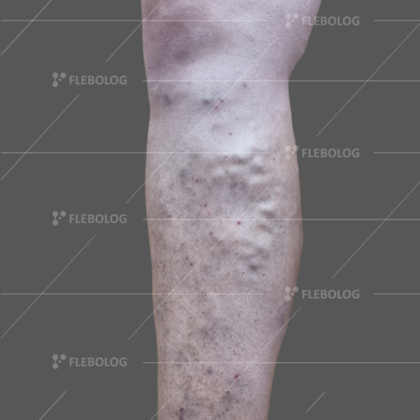 варикоз на коліні фото до та після операції - флеболог Барабой