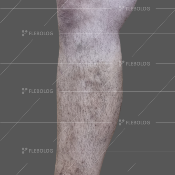 варикоз на коліні фото до та після операції - флеболог Барабой