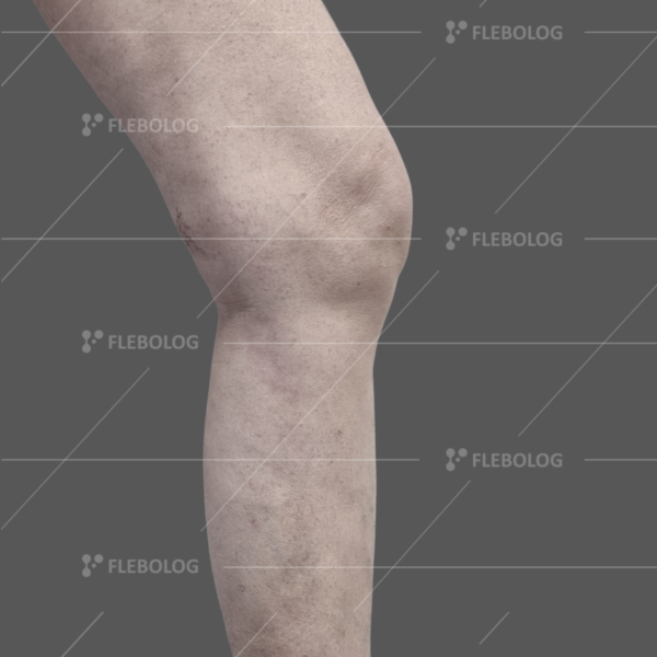 розкриті вени фото після операції - флеболог Барабой