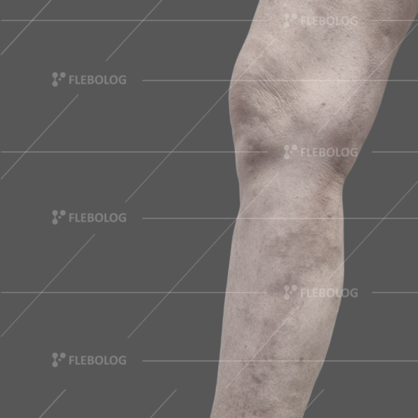 Лечение варикоза до и после - флеболог Барабой, фото 88