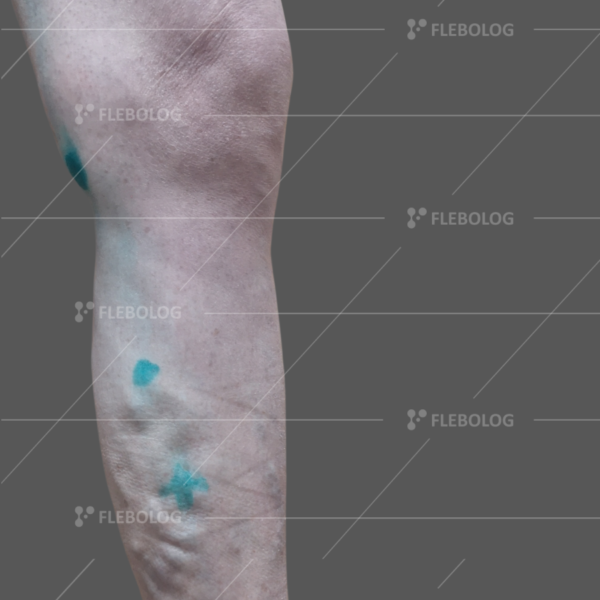 Лечение варикоза до и после - флеболог Барабой, фото 89