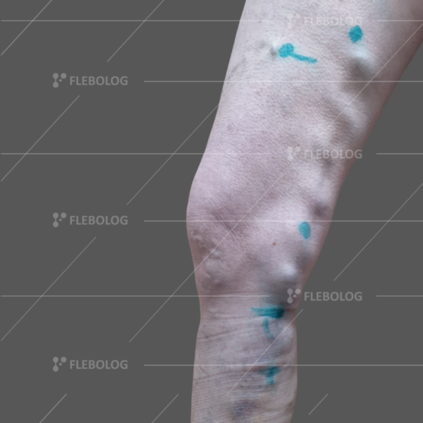 Лечение варикоза до и после - флеболог Барабой, фото 87