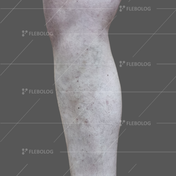 Лечение варикоза до и после - флеболог Барабой, фото 70