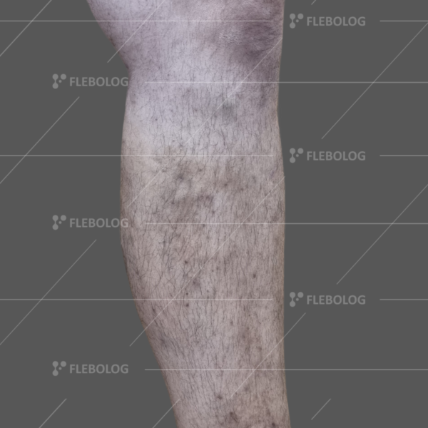 Лечение варикоза до и после - флеболог Барабой, фото 64