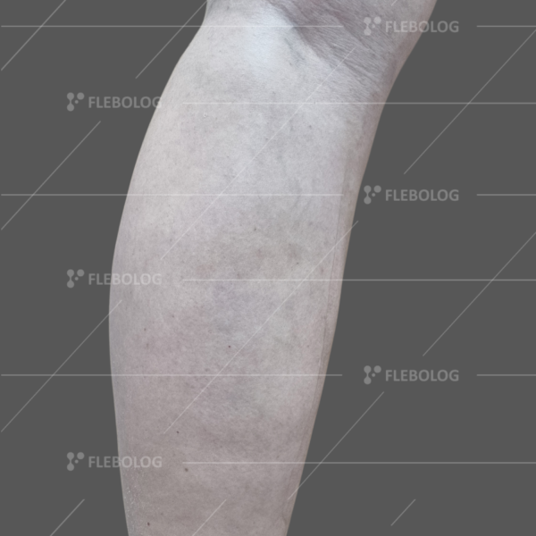 Лечение варикоза до и после - флеболог Барабой, фото 60