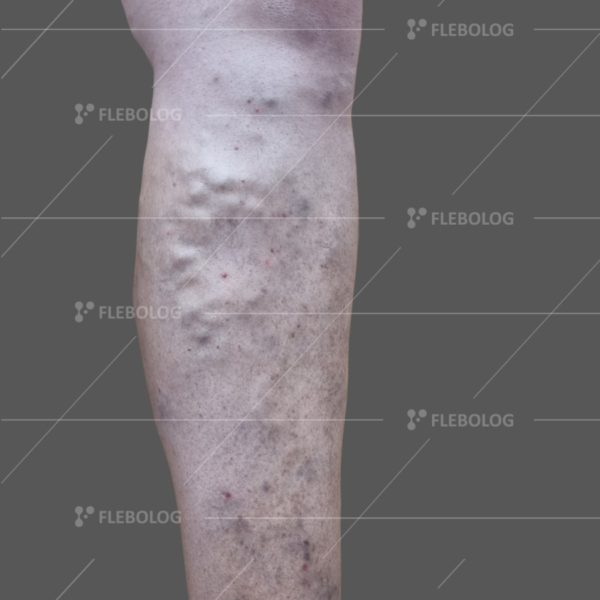 Лечение варикоза до и после - флеболог Барабой, фото 63