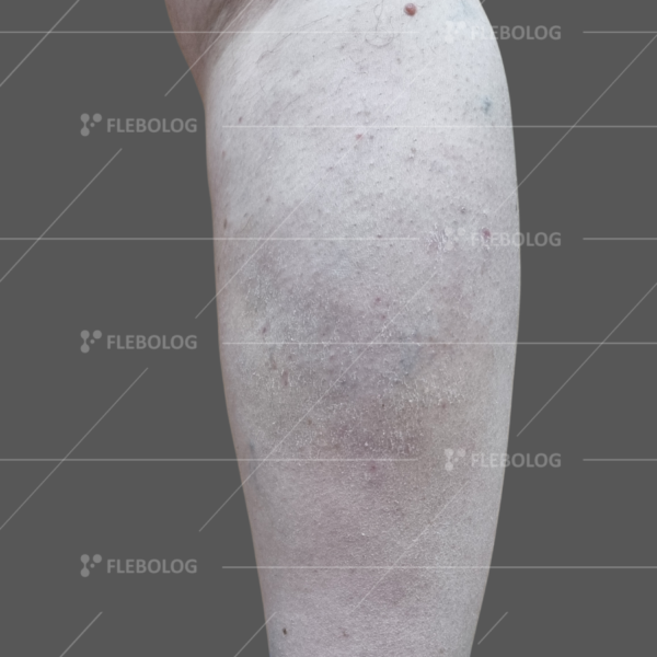Лечение варикоза до и после - флеболог Барабой, фото 33