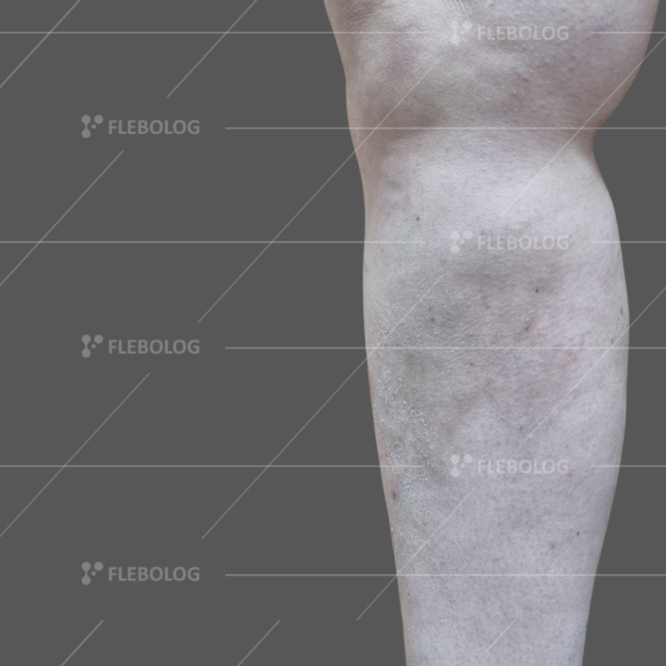 Лечение варикоза до и после - флеболог Барабой, фото 31