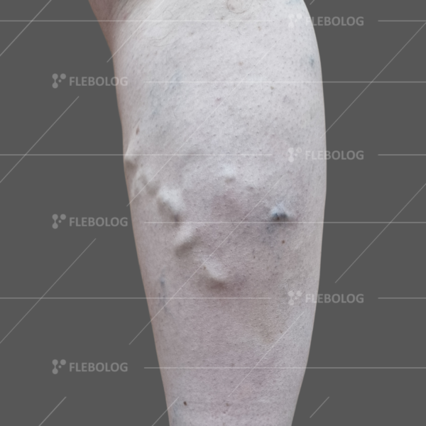 Лечение варикоза до и после - флеболог Барабой, фото 32