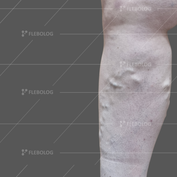 Лечение варикоза до и после - флеболог Барабой, фото 30