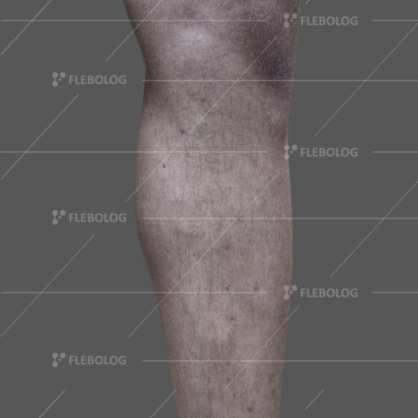 Лечение варикоза до и после - флеболог Барабой, фото 74