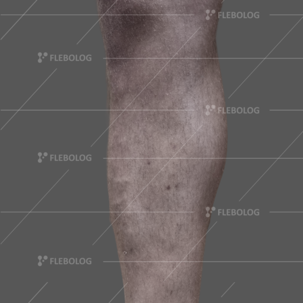 Лечение варикоза до и после - флеболог Барабой, фото 72