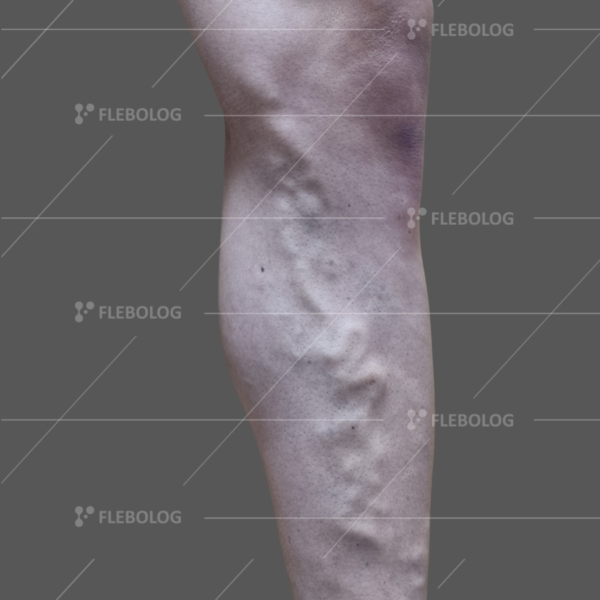 Лечение варикоза до и после - флеболог Барабой, фото 73