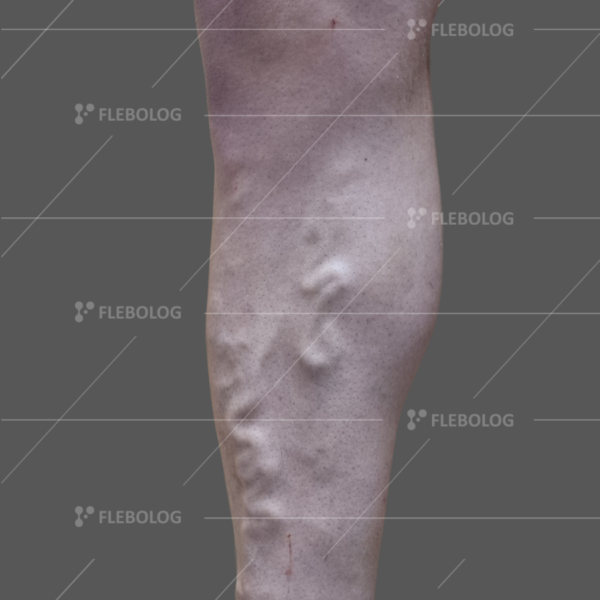 Лечение варикоза до и после - флеболог Барабой, фото 71