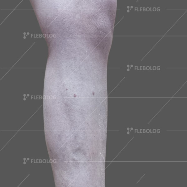 Лечение варикоза до и после - флеболог Барабой, фото 68