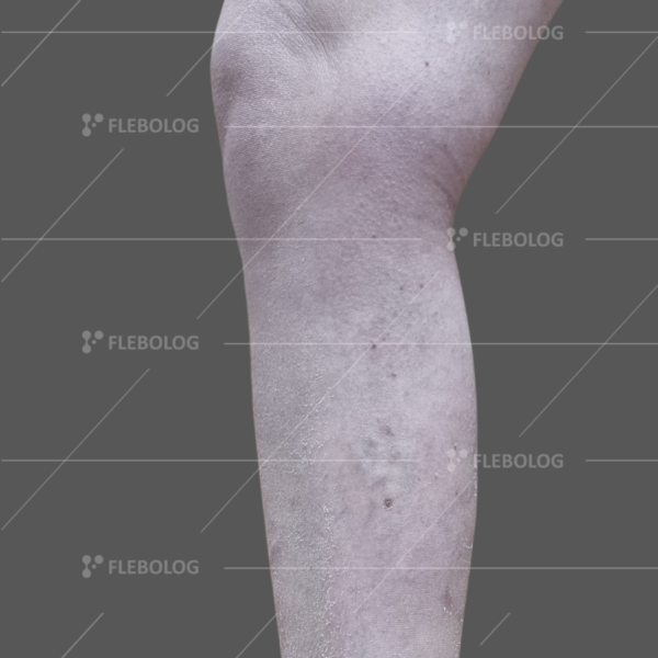 Лечение варикоза до и после - флеболог Барабой, фото 66