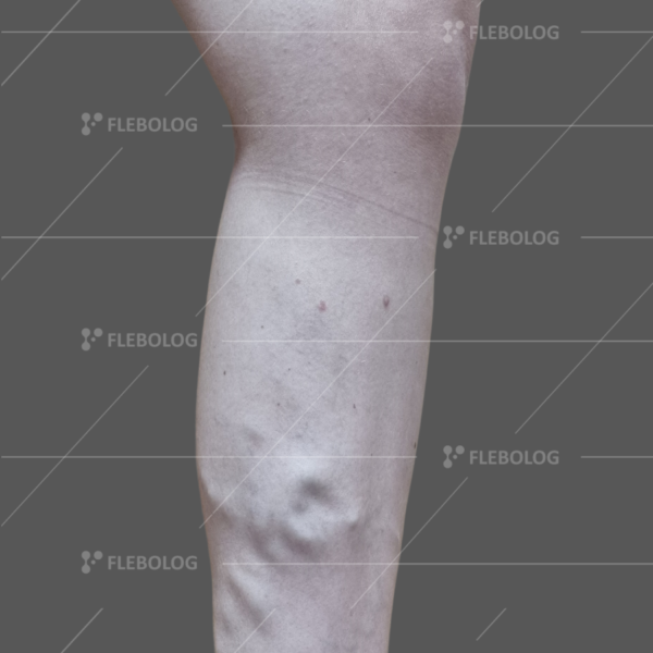 Лечение варикоза до и после - флеболог Барабой, фото 67