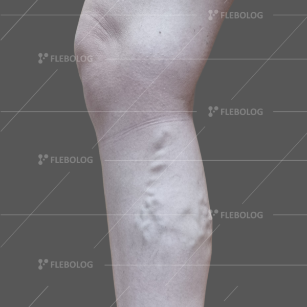 Лечение варикоза до и после - флеболог Барабой, фото 65