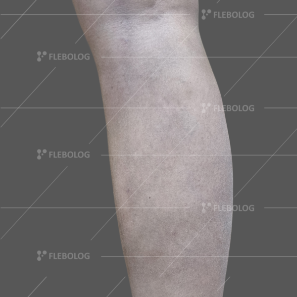 Лечение варикоза до и после - флеболог Барабой, фото 58