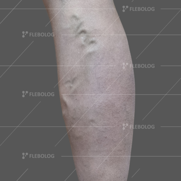 Лечение варикоза до и после - флеболог Барабой, фото 57