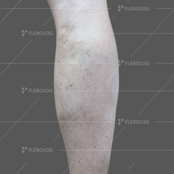 Лечение варикоза до и после - флеболог Барабой, фото 56