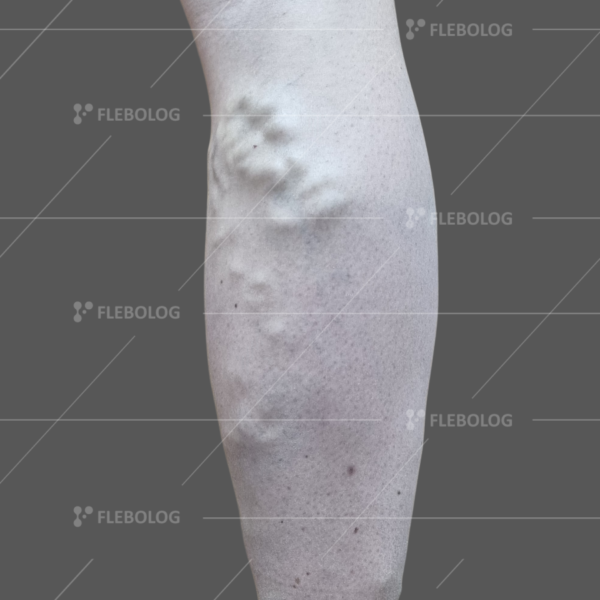 Лечение варикоза до и после - флеболог Барабой, фото 55