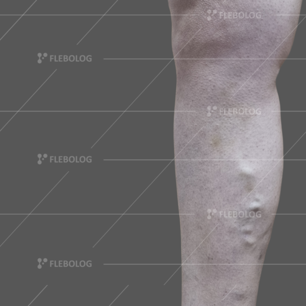 Лечение варикоза до и после - флеболог Барабой, фото 53