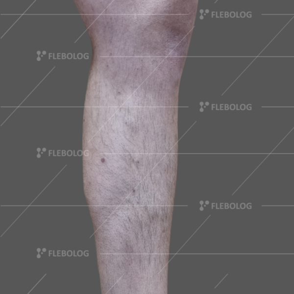 Лечение варикоза до и после - флеболог Барабой, фото 52