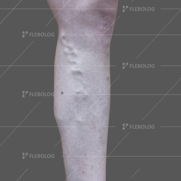 Лечение варикоза до и после - флеболог Барабой, фото 51