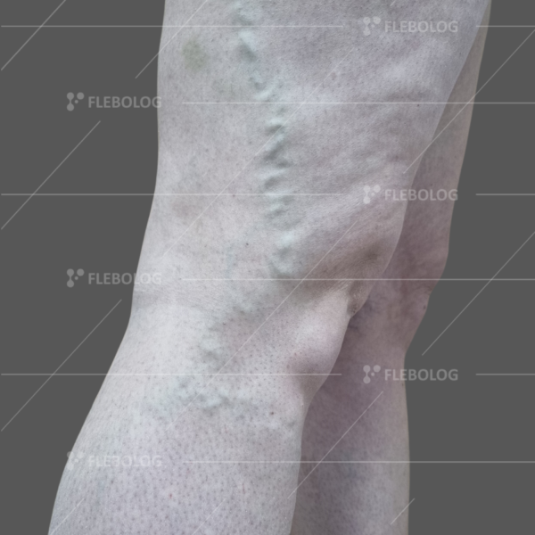 Лечение варикоза до и после - флеболог Барабой, фото 44