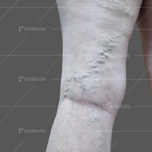 Лечение варикоза до и после - флеболог Барабой, фото 42