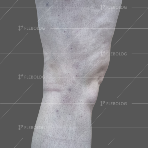 Лечение варикоза до и после - флеболог Барабой, фото 45